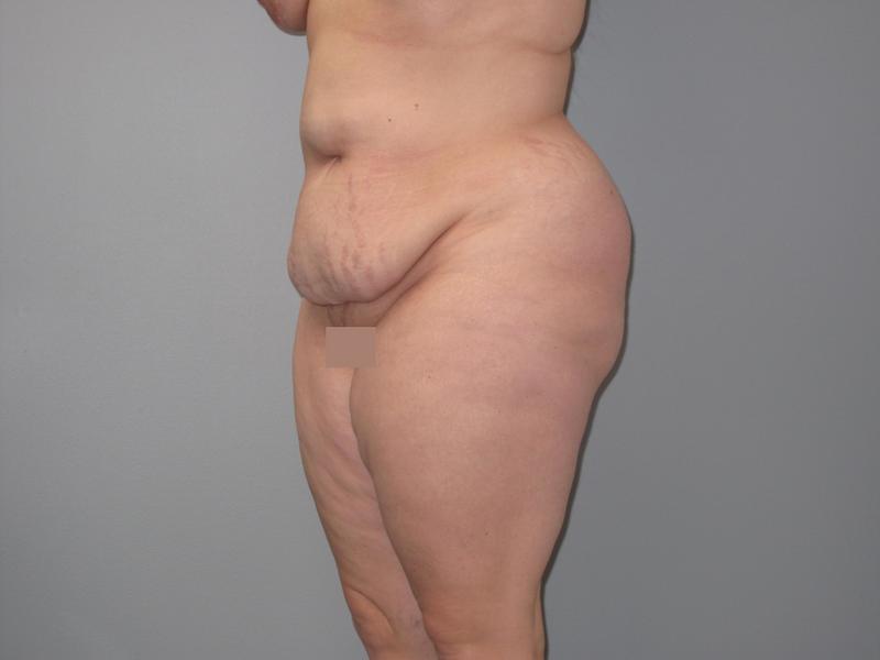 Dr. Mark Walker MD - Body - Tummy Tucks (Abdominoplasty