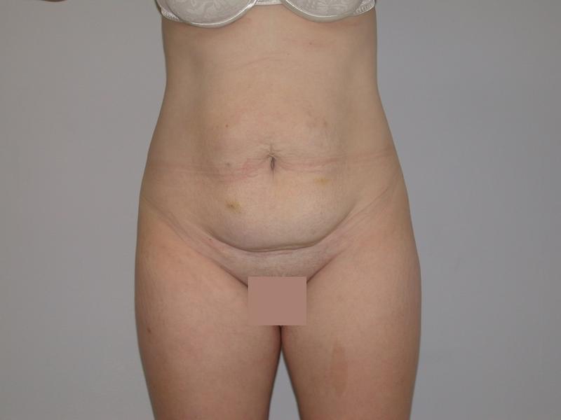 Dr. Mark Walker MD - Body - Tummy Tucks (Abdominoplasty