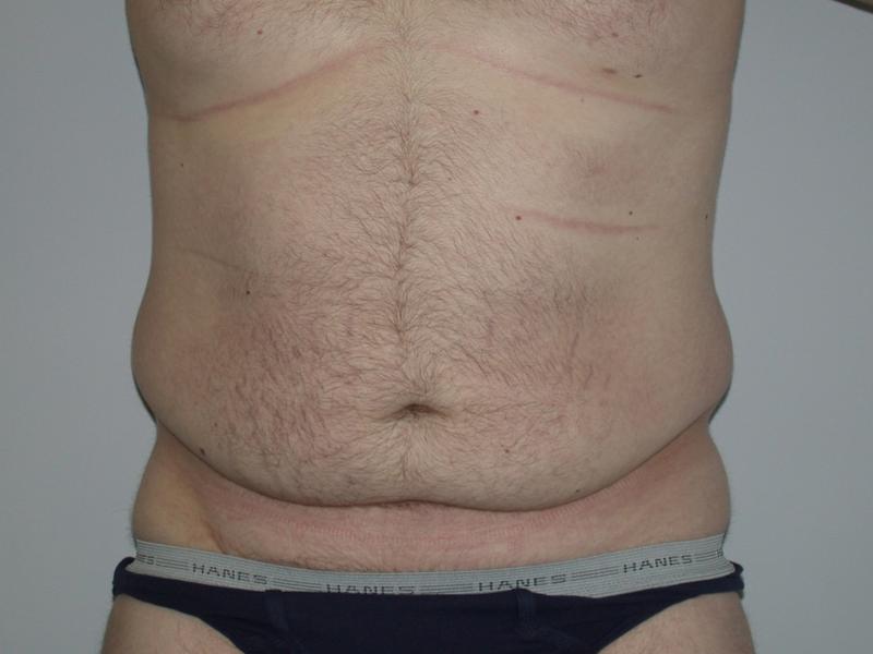 Dr. Mark Walker MD - Body - Tummy Tucks (Abdominoplasty