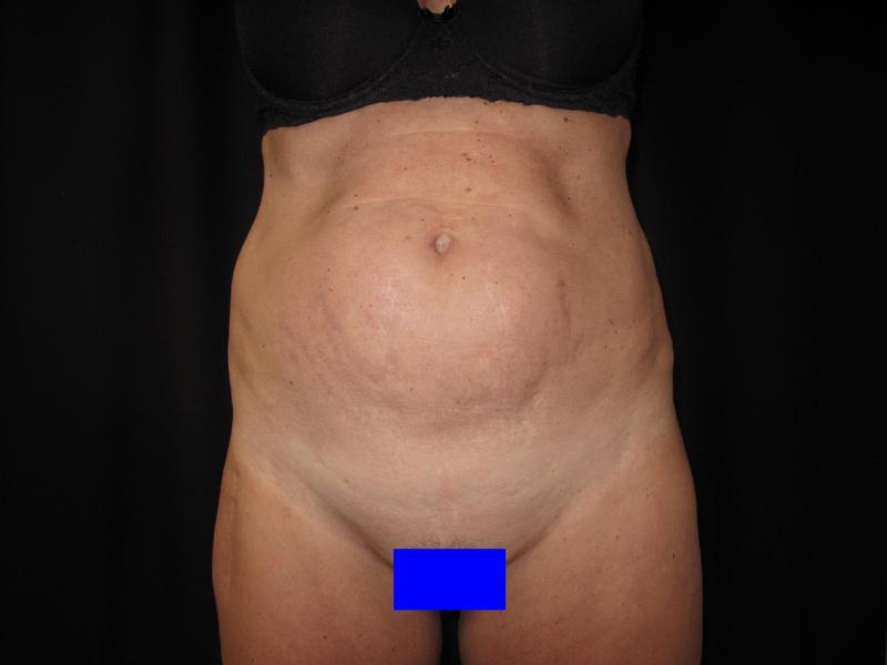 Dr. Mark Walker MD - Body - Tummy Tucks (Abdominoplasty