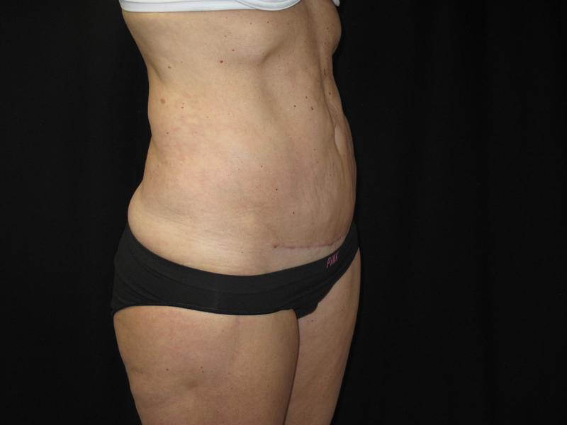 Dr. Mark Walker MD - Body - Tummy Tucks (Abdominoplasty