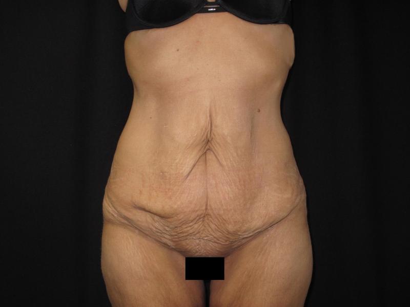 Dr. Mark Walker MD - Body - Tummy Tucks (Abdominoplasty