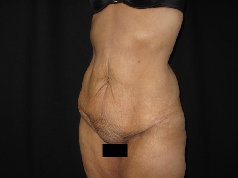 Dr. Mark Walker MD - Body - Tummy Tucks (Abdominoplasty