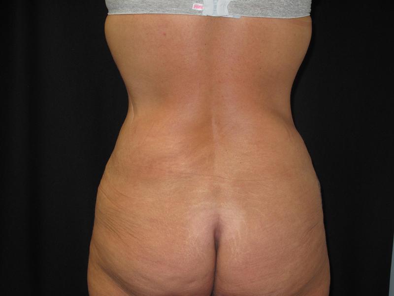 Dr. Mark Walker MD - Body - Tummy Tucks (Abdominoplasty