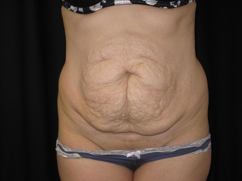 Dr. Mark Walker MD - Body - Tummy Tucks (Abdominoplasty