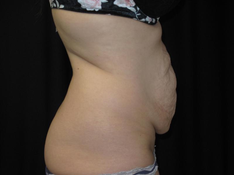 Dr. Mark Walker MD - Body - Tummy Tucks (Abdominoplasty