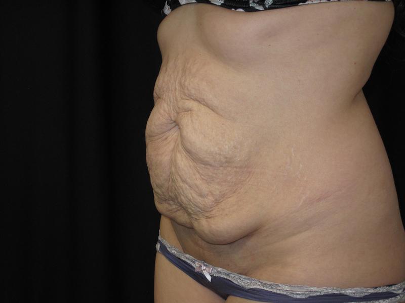 Dr. Mark Walker MD - Body - Tummy Tucks (Abdominoplasty